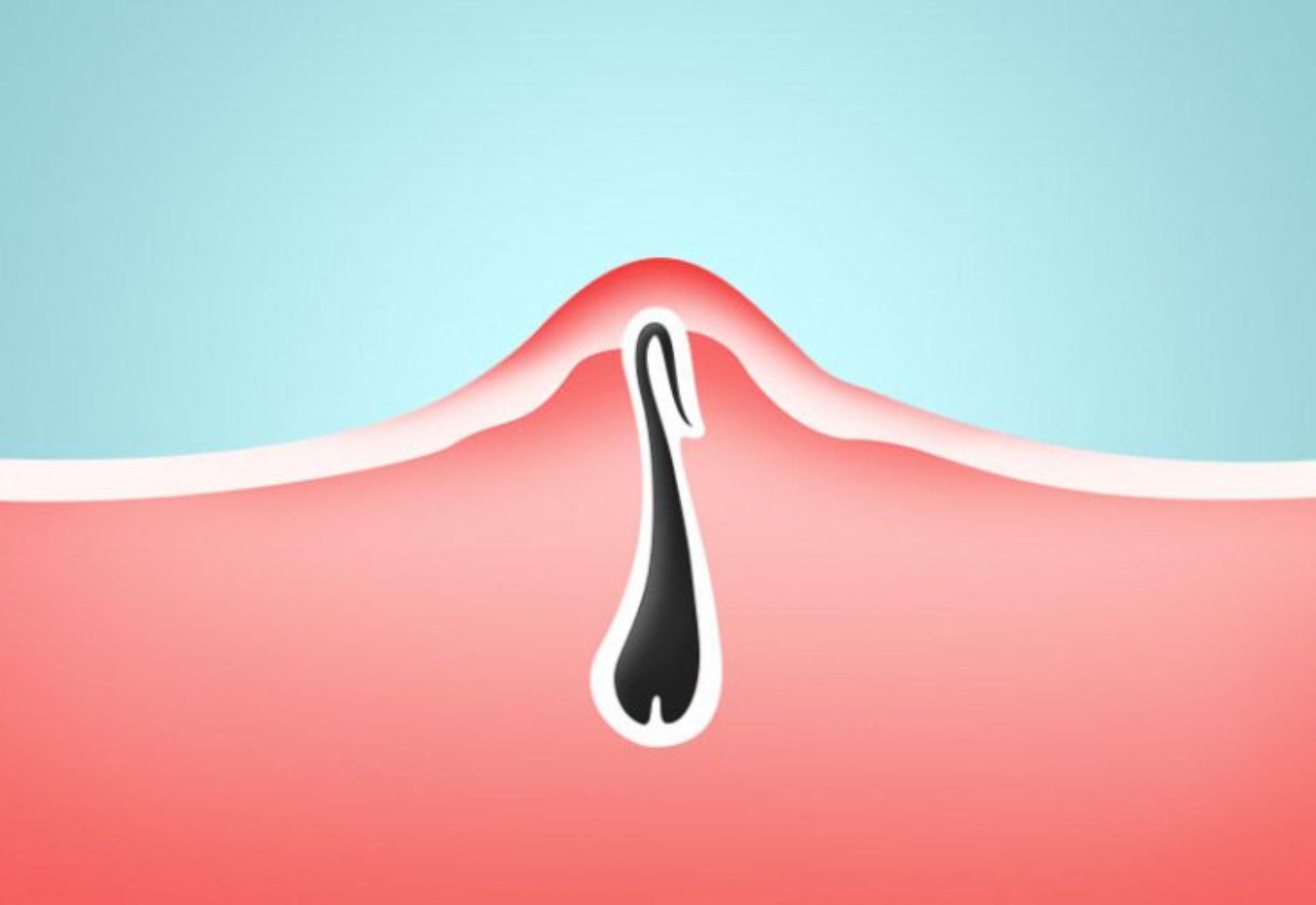 Τρίχες που γυρίζουν προς τα μέσα – Τι φταίει και πώς θα το αντιμετωπίσεις