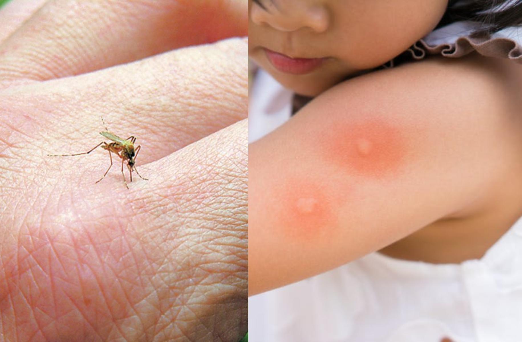Χαμός από κουνούπια το φετινό καλοκαίρι: Πως θα προστατέψετε τα παιδιά από τα τσιμπήματα και θα τα αντιμετωπίσετε