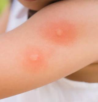 7-κόλπα-για-να-μην-μας-τσιμπάνε-τα-κουνούπια-