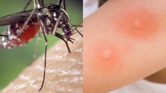 7 κόλπα για να μην σας τσιμπάνε τα κουνούπια το Καλοκαίρι