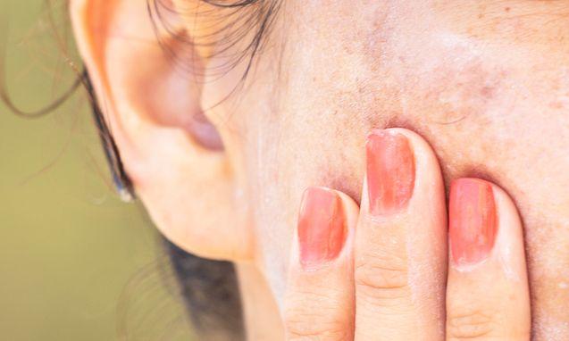 Σπυράκια κάψιμο και ξεφλούδισμα: Οι ασθένειες του ήλιου και τα συμπτώματα τους