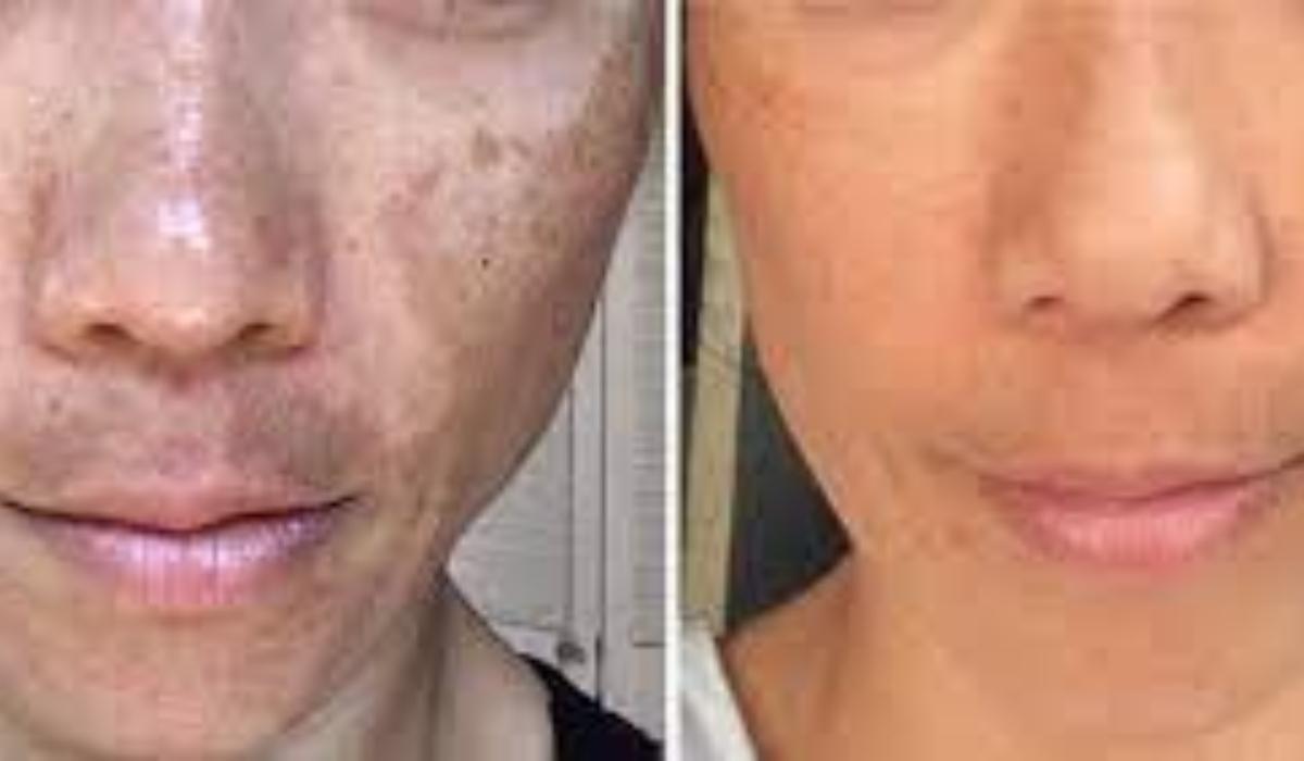 Σπυράκια κάψιμο και ξεφλούδισμα: Οι ασθένειες του ήλιου και τα συμπτώματα τους