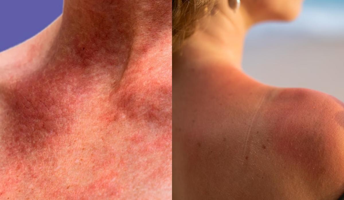 Σπυράκια κάψιμο και ξεφλούδισμα: Οι ασθένειες του ήλιου και τα συμπτώματα τους