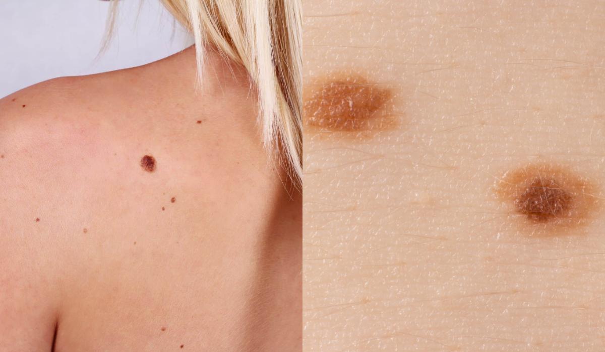 Σπυράκια κάψιμο και ξεφλούδισμα: Οι ασθένειες του ήλιου και τα συμπτώματα τους