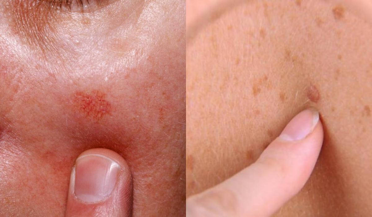 Σπυράκια κάψιμο και ξεφλούδισμα: Οι ασθένειες του ήλιου και τα συμπτώματα τους