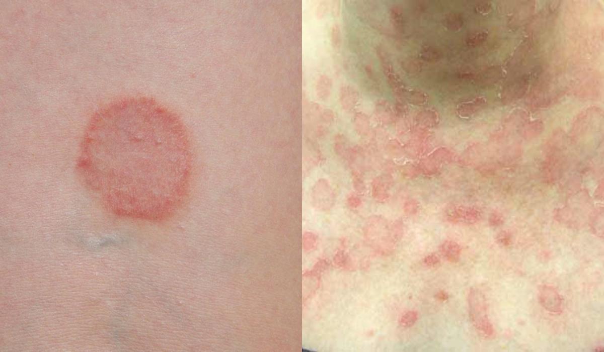 Σπυράκια κάψιμο και ξεφλούδισμα: Οι ασθένειες του ήλιου και τα συμπτώματα τους