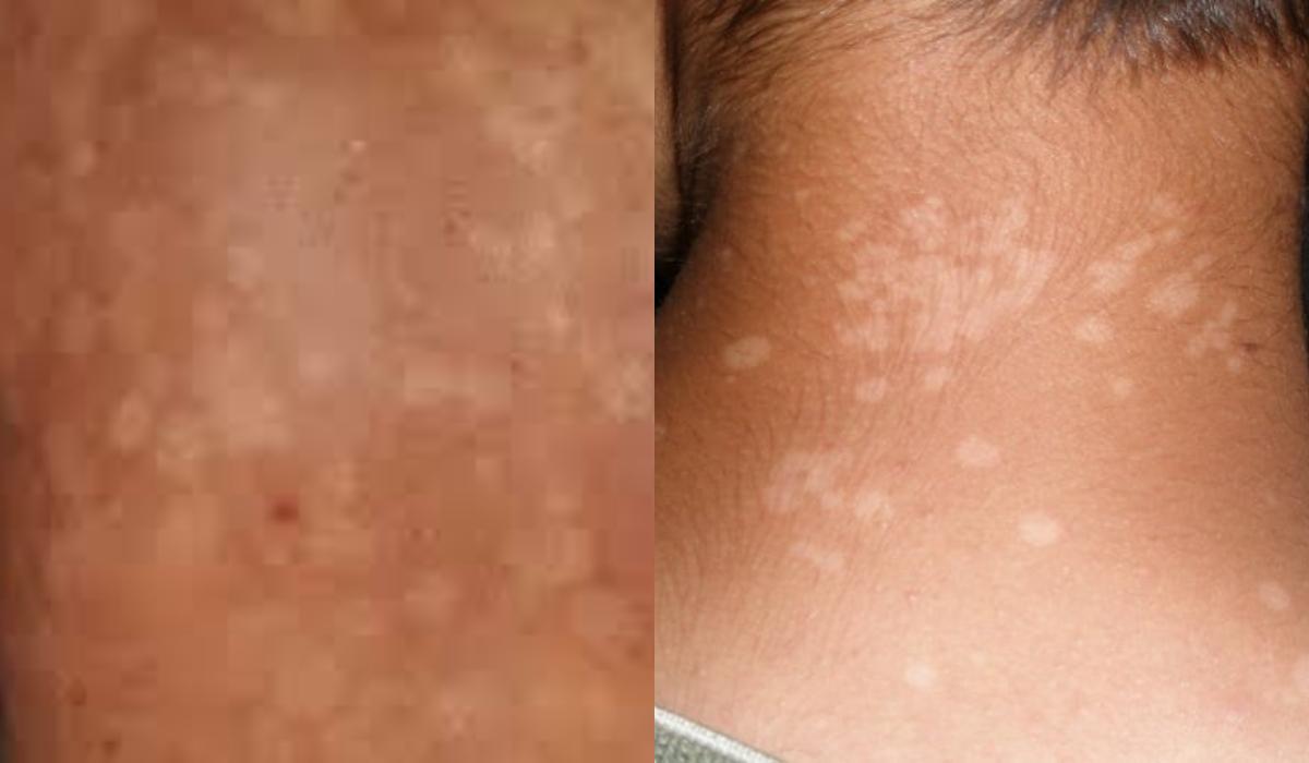 Σπυράκια κάψιμο και ξεφλούδισμα: Οι ασθένειες του ήλιου και τα συμπτώματα τους