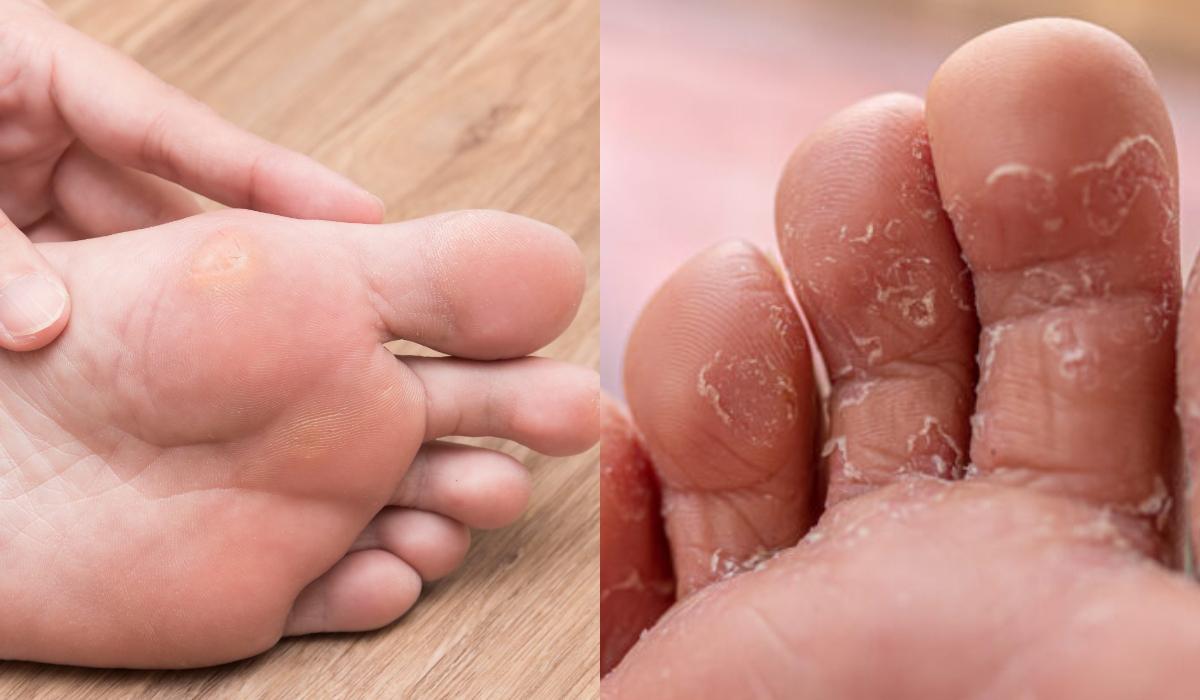 Σπυράκια κάψιμο και ξεφλούδισμα: Οι ασθένειες του ήλιου και τα συμπτώματα τους