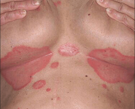 Σπυράκια κάψιμο και ξεφλούδισμα: Οι ασθένειες του ήλιου και τα συμπτώματα τους