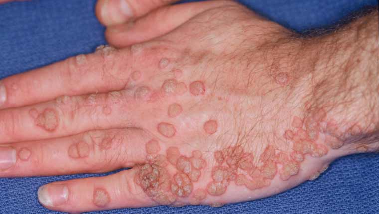 Σπυράκια κάψιμο και ξεφλούδισμα: Οι ασθένειες του ήλιου και τα συμπτώματα τους