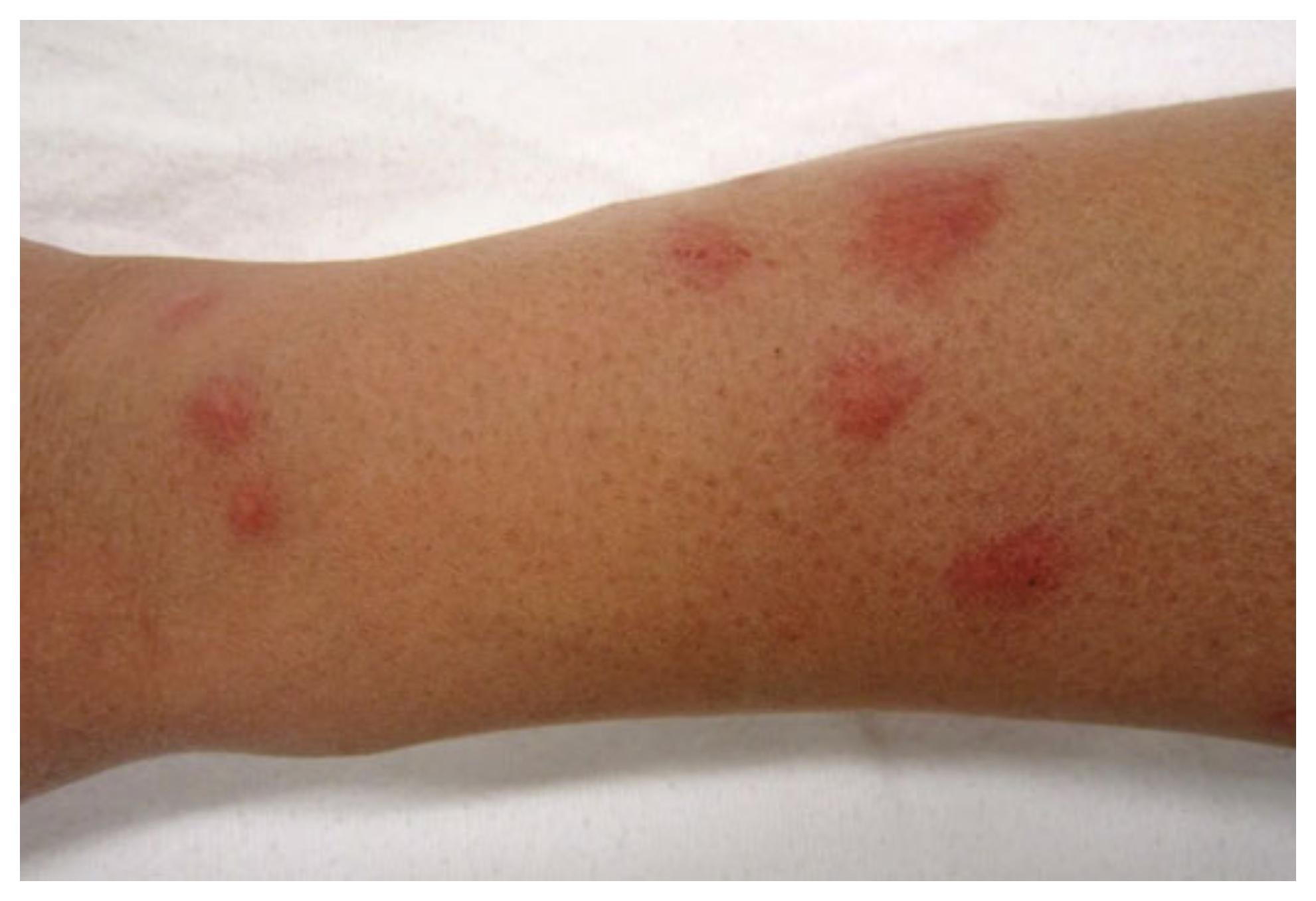 Το τσίμπημα κατσαρίδας μπορεί να αποβεί μοιραίο: Δες φώτο και αναγνώρισέ το