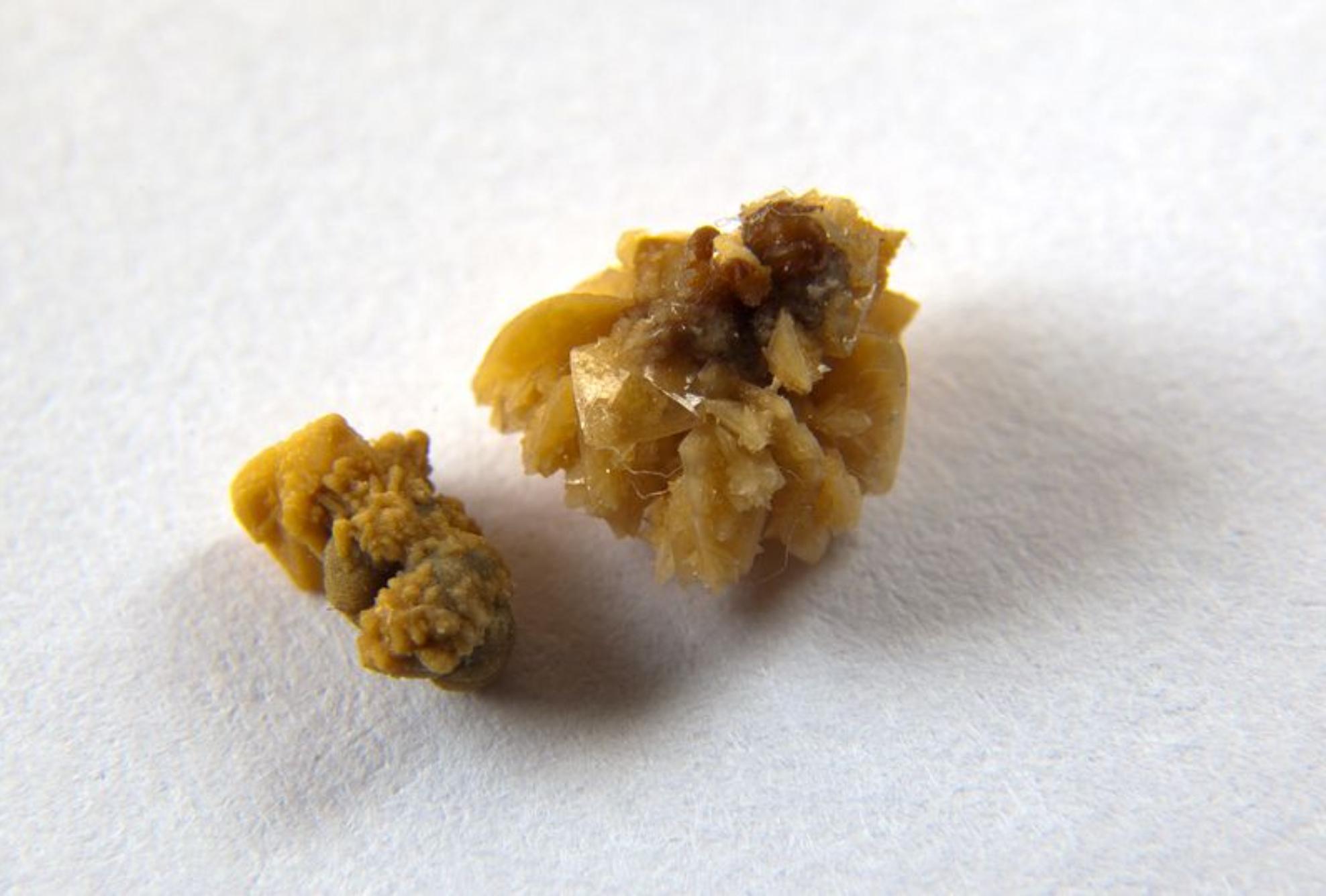 Πέτρες στα νεφρά: Αυξημένες πιθανότητες να σχηματισμού τους το καλοκαίρι είναι – Τι να κάνετε για να το αποφύγετε