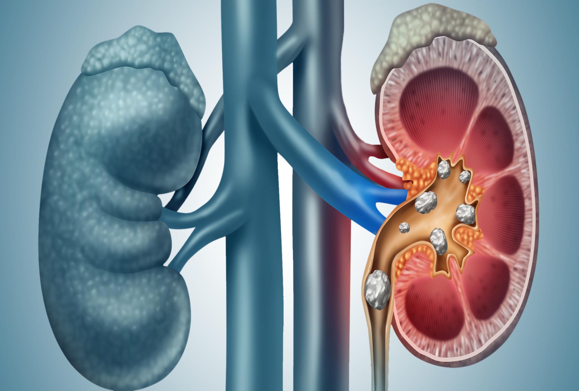 Πέτρες στα νεφρά: Αυξημένες πιθανότητες να σχηματισμού τους το καλοκαίρι είναι – Τι να κάνετε για να το αποφύγετε