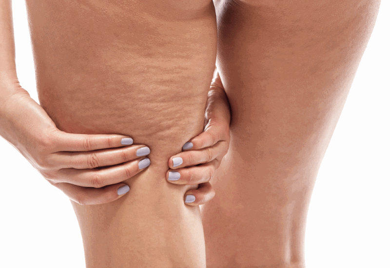 Σπιτικές κρέμες για κυτταρίτιδα και αδυνάτισμα σε περιφέρεια, κοιλιά και γλουτούς