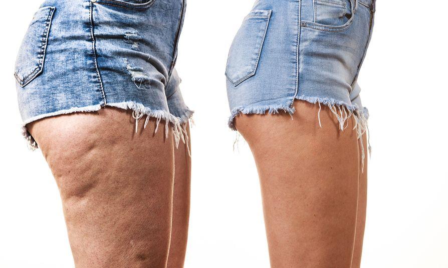 σπιτικές-κρέμες ομορφιάς-για-κυτταρίτιδα-και-αδυνάτισμα-σε-γλουτούς-περιφέρεια-και-κοιλιά-