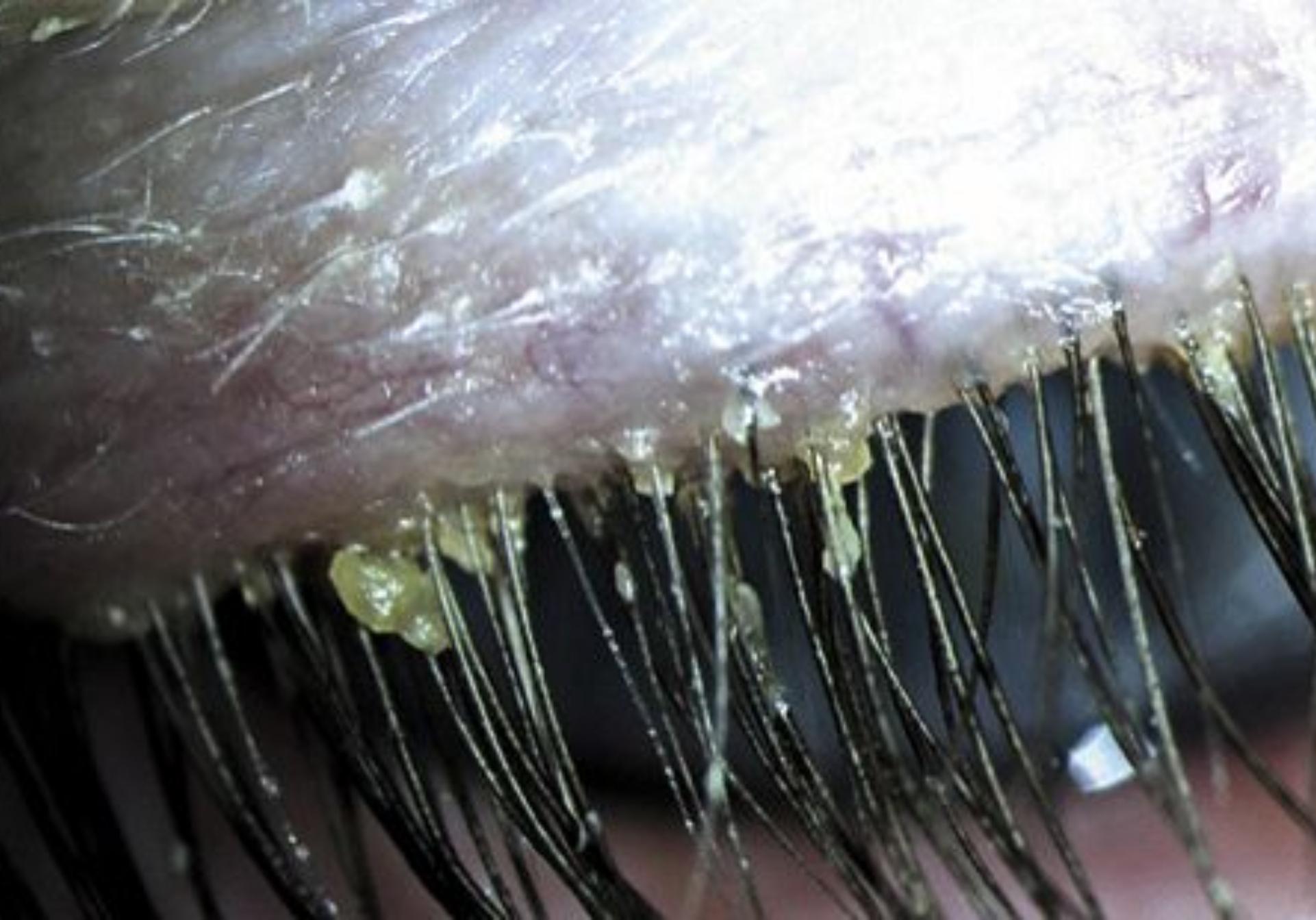 Ψείρες: Έκαναν φωλιά στις βλεφαρίδες ενός 3χρονου παιδιού (φωτογραφίες)