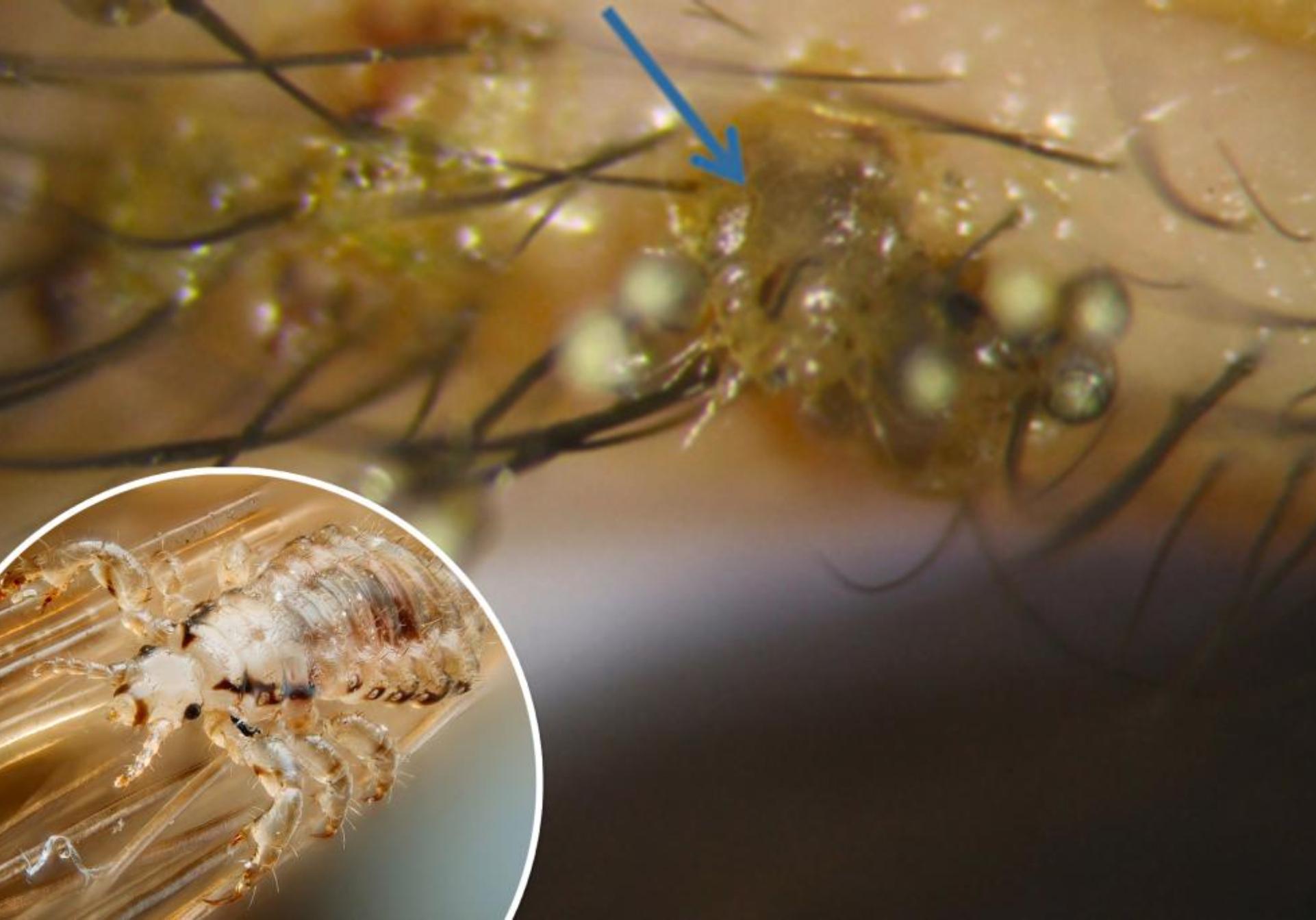 Ψείρες: Έκαναν φωλιά στις βλεφαρίδες ενός 3χρονου παιδιού (φωτογραφίες)