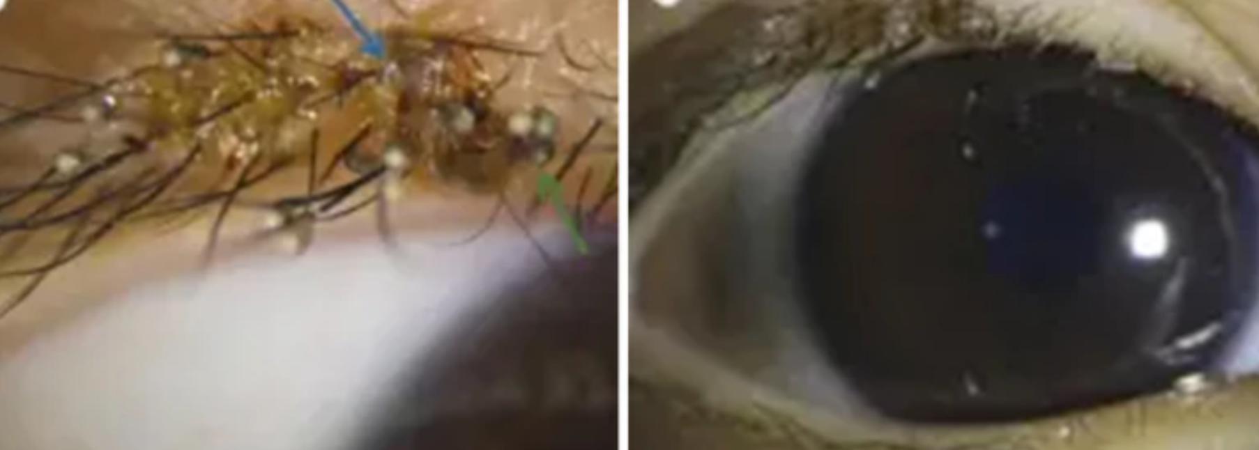 Ψείρες: Έκαναν φωλιά στις βλεφαρίδες ενός 3χρονου παιδιού (φωτογραφίες)