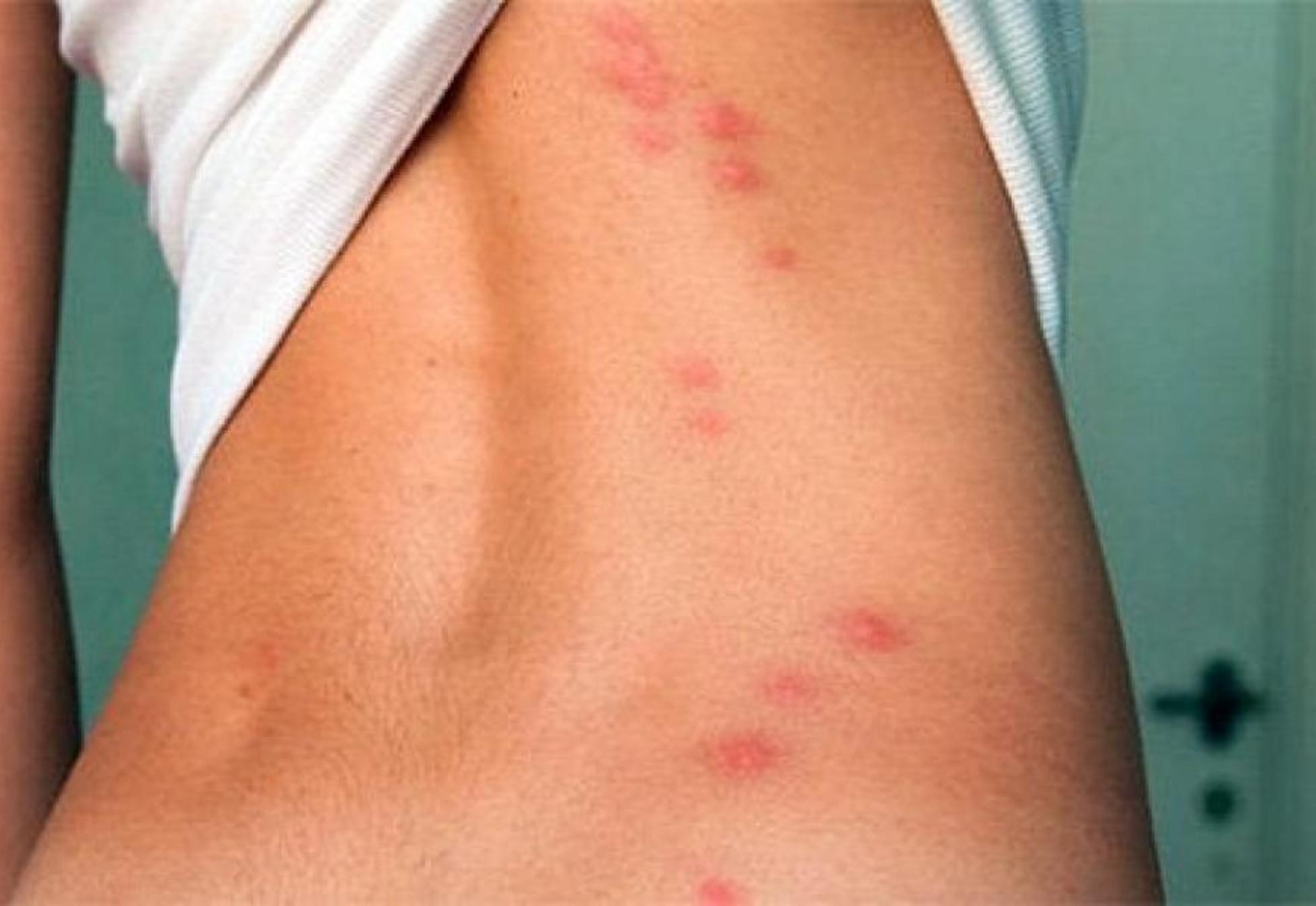 Ψύλλος κοριός η ψαλίδα; Δες εικόνες για να καταλάβεις τι σε τσίμπησε