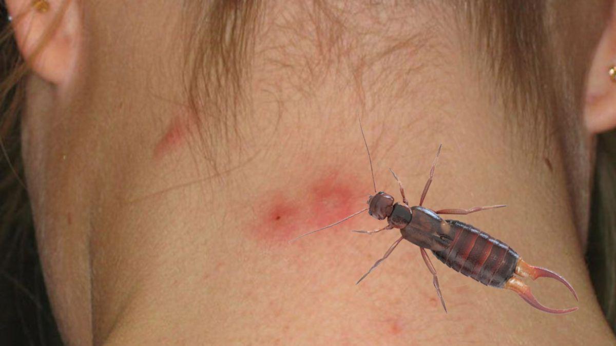 Ψύλλος κοριός η ψαλίδα; Δες εικόνες για να καταλάβεις τι σε τσίμπησε