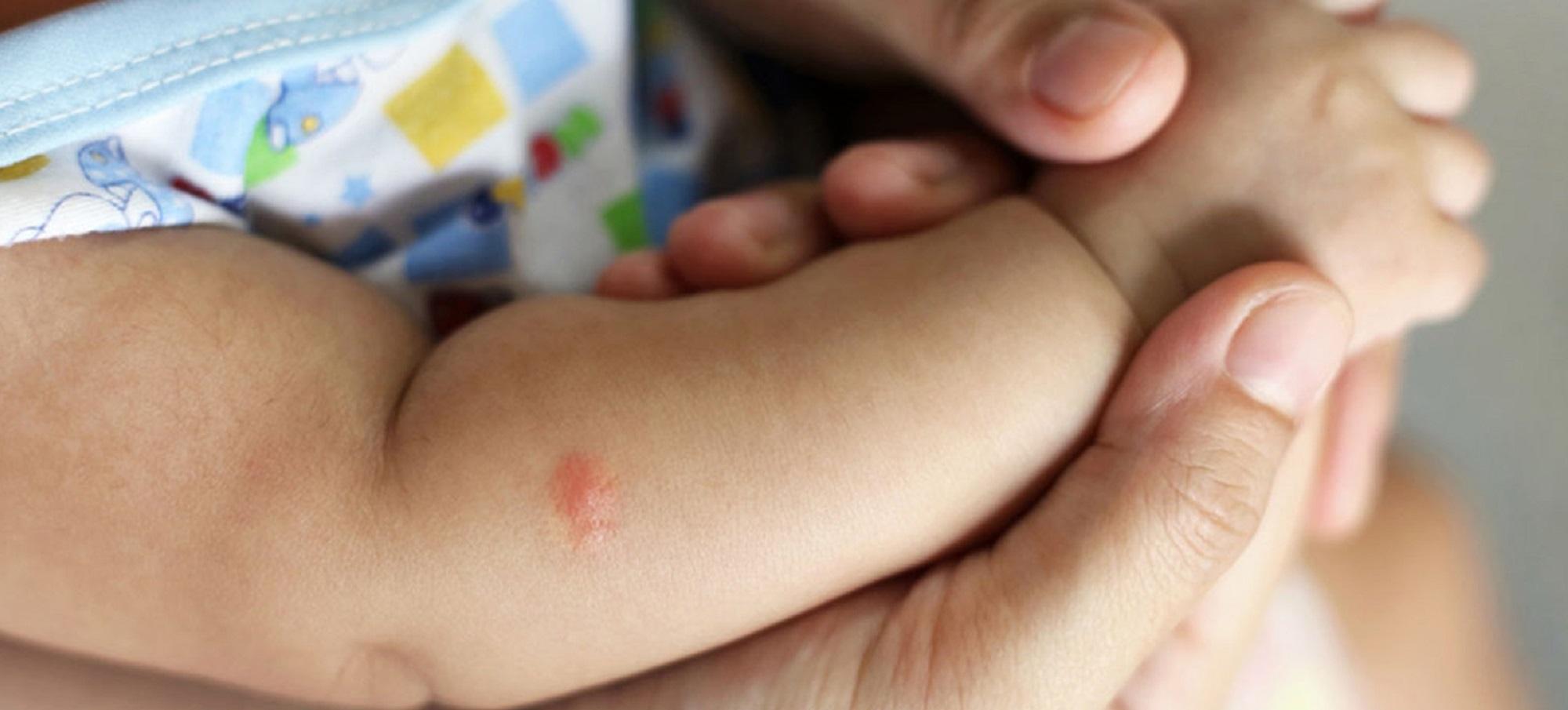 Ψύλλος κοριός η ψαλίδα; Δες εικόνες για να καταλάβεις τι σε τσίμπησε