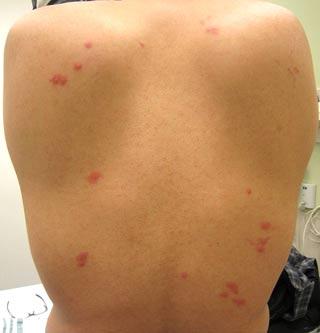 Ψύλλος κοριός η ψαλίδα; Δες εικόνες για να καταλάβεις τι σε τσίμπησε