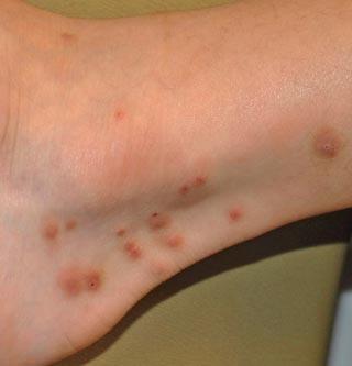 Ψύλλος κοριός η ψαλίδα; Δες εικόνες για να καταλάβεις τι σε τσίμπησε