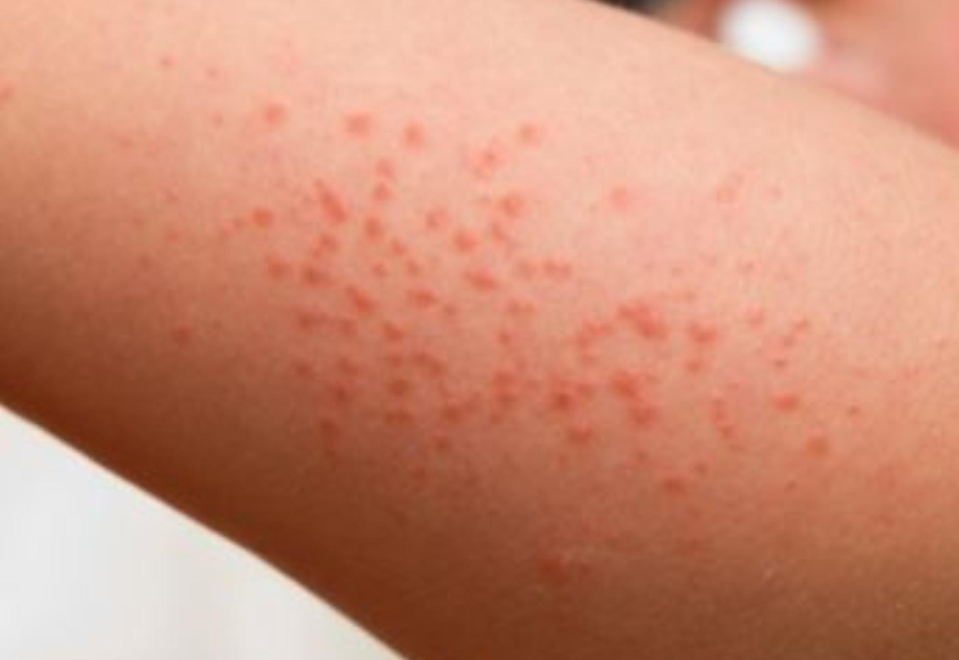 Τσιμπήματα από έντομα