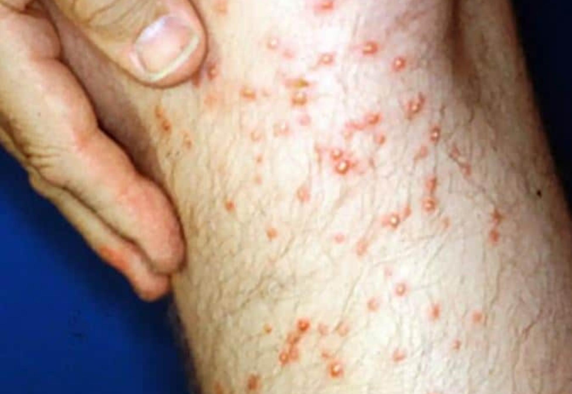 Τσιμπήματα από έντομα