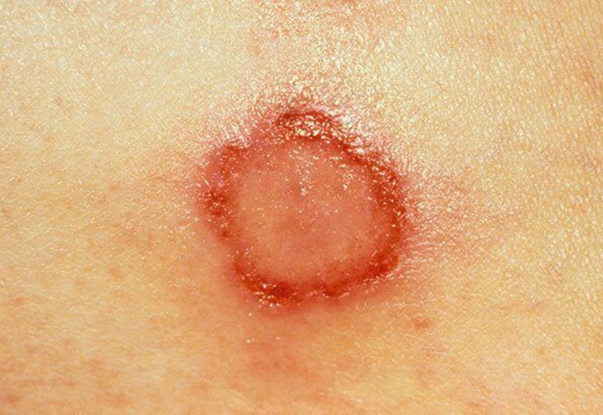 Τσιμπήματα από έντομα