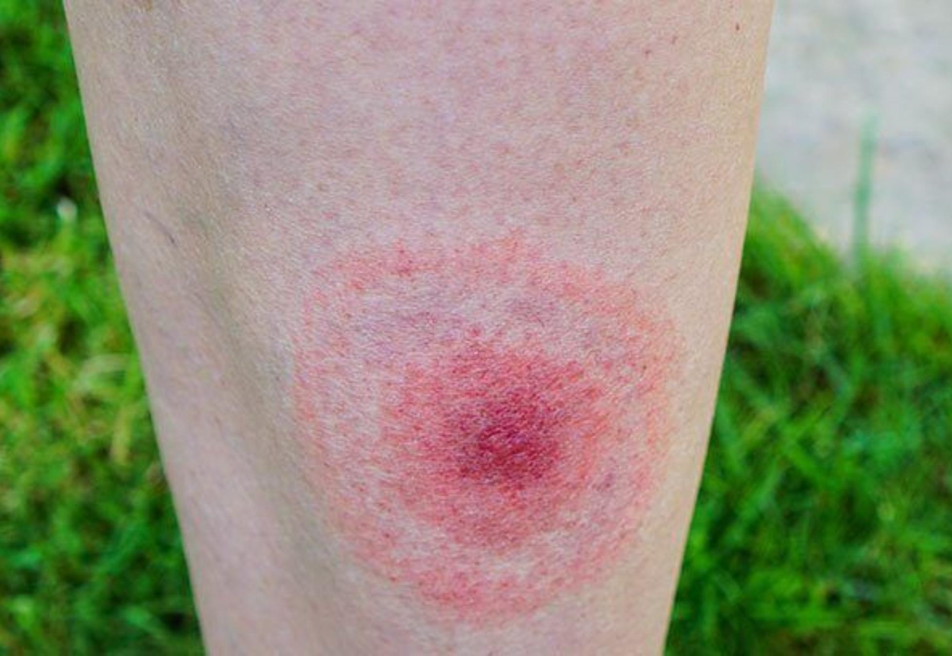 Τσιμπήματα από έντομα