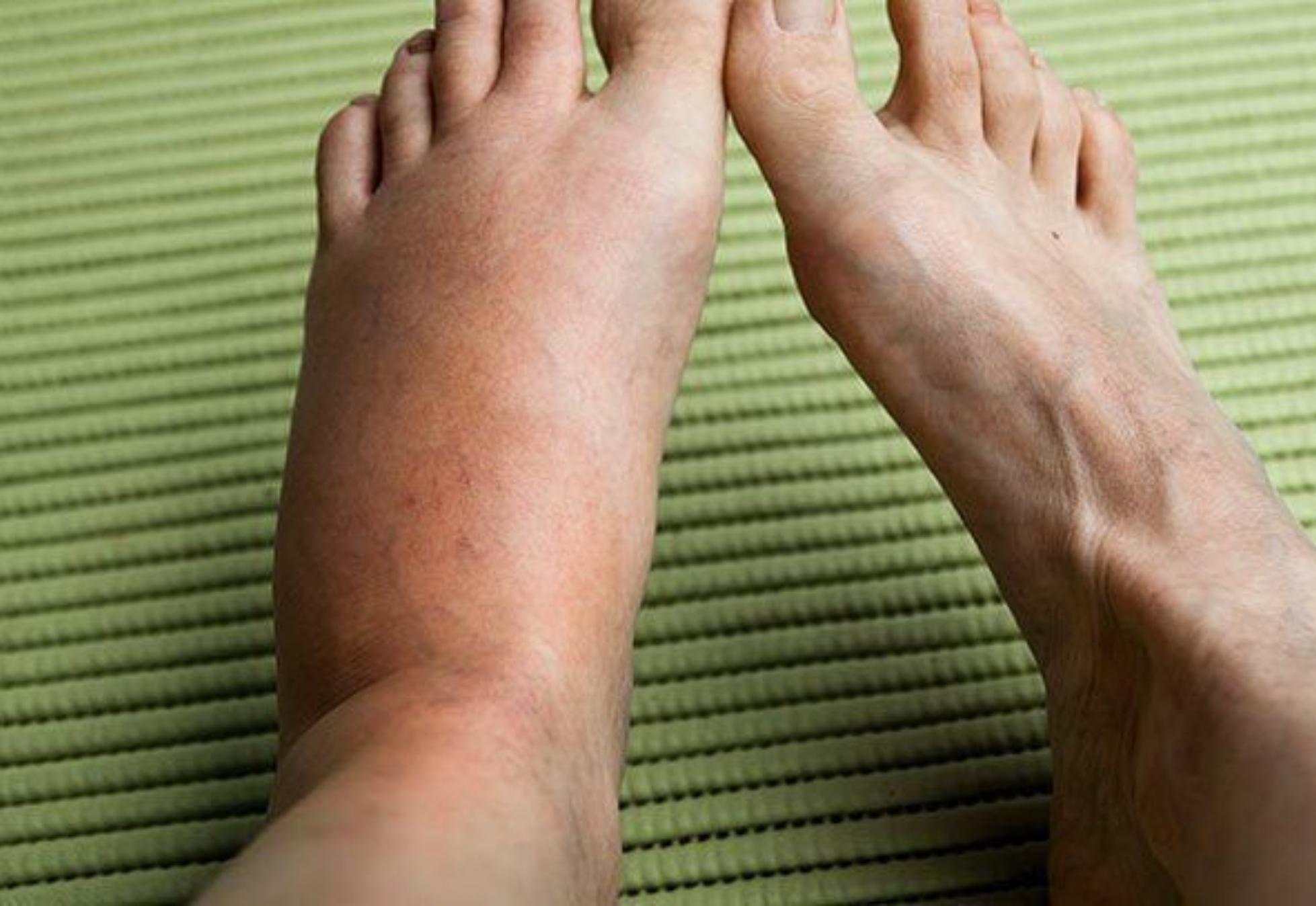 Τσιμπήματα από έντομα