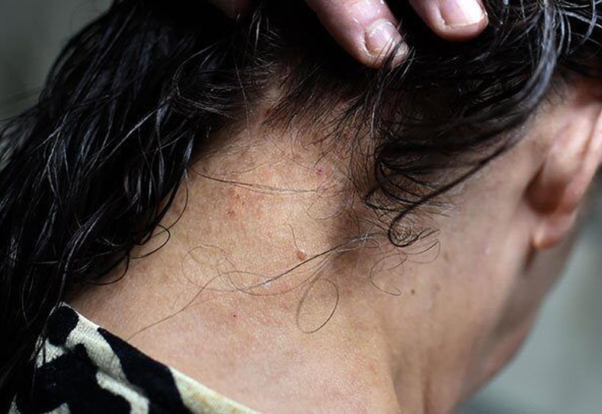 Τσιμπήματα από έντομα