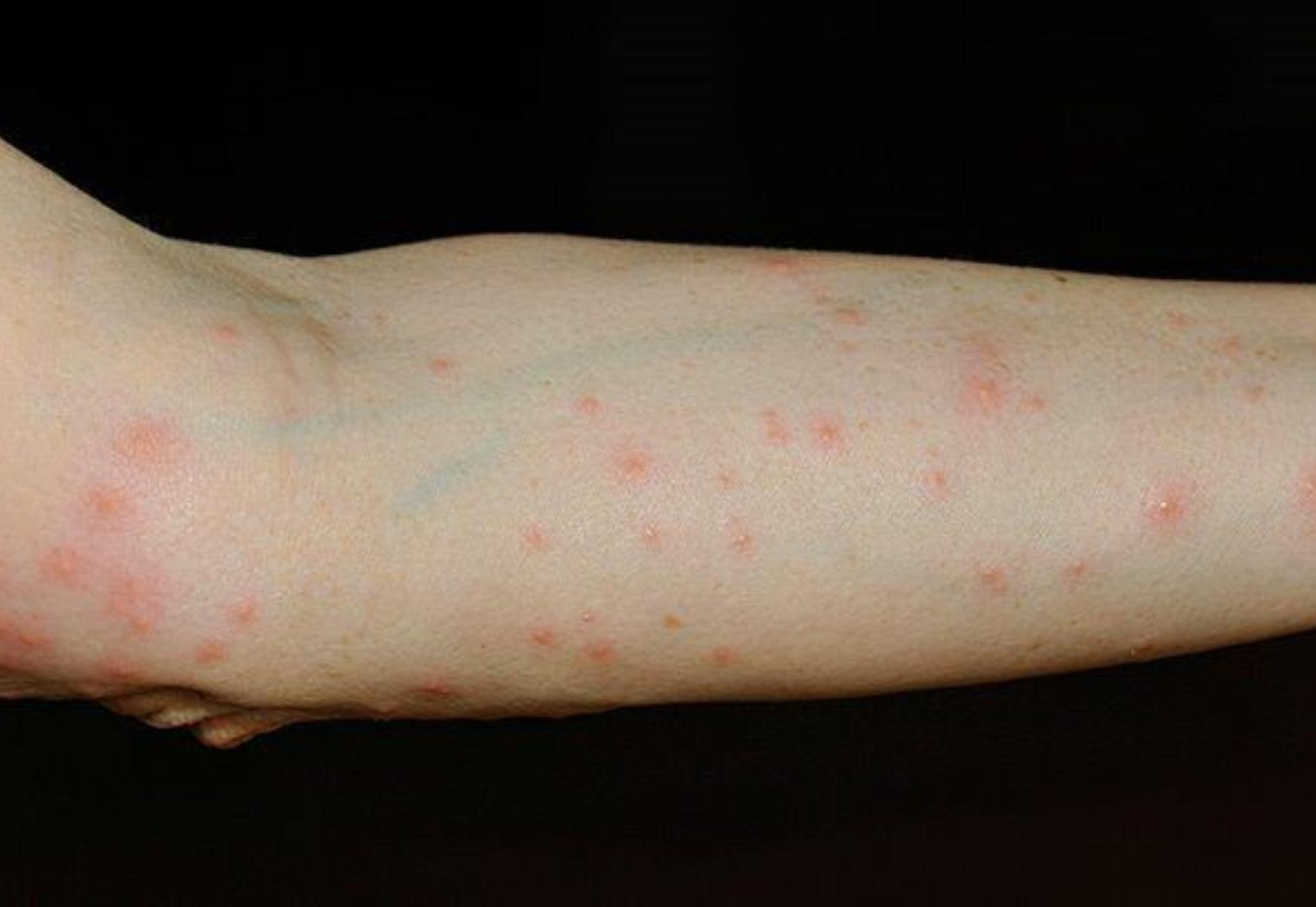 Τσιμπήματα από έντομα