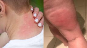 Σύνδρομο Skeeter: Αλλεργική αντίδραση σε τσίμπημα κουνουπιού  και τι να κάνετε