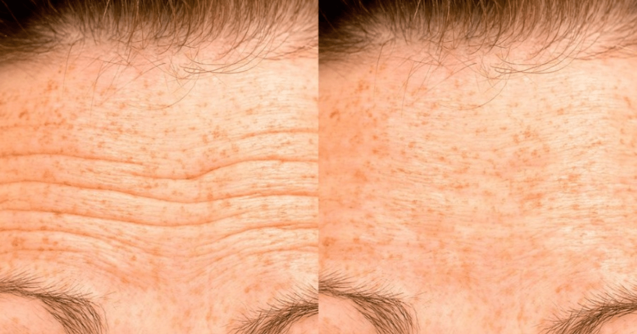 ρυτίδες-στο-μέτωπο-ή-γραμμές αφυδάτωσης-πως-να-τις-ξεχωρίζεις-αντιμετώπιση- ρυτίδες-στο-μέτωπο-ή-γραμμές αφυδάτωσης-πως-να-τις-ξεχωρίζεις-αντιμετώπιση-