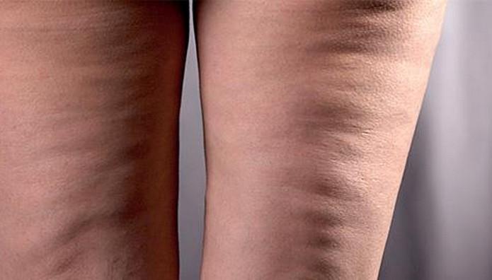 λαδάκι-για-την-κυτταρίτιδα-και-το-λίπος- λαδάκι-για-την-κυτταρίτιδα-και-το-λίπος-