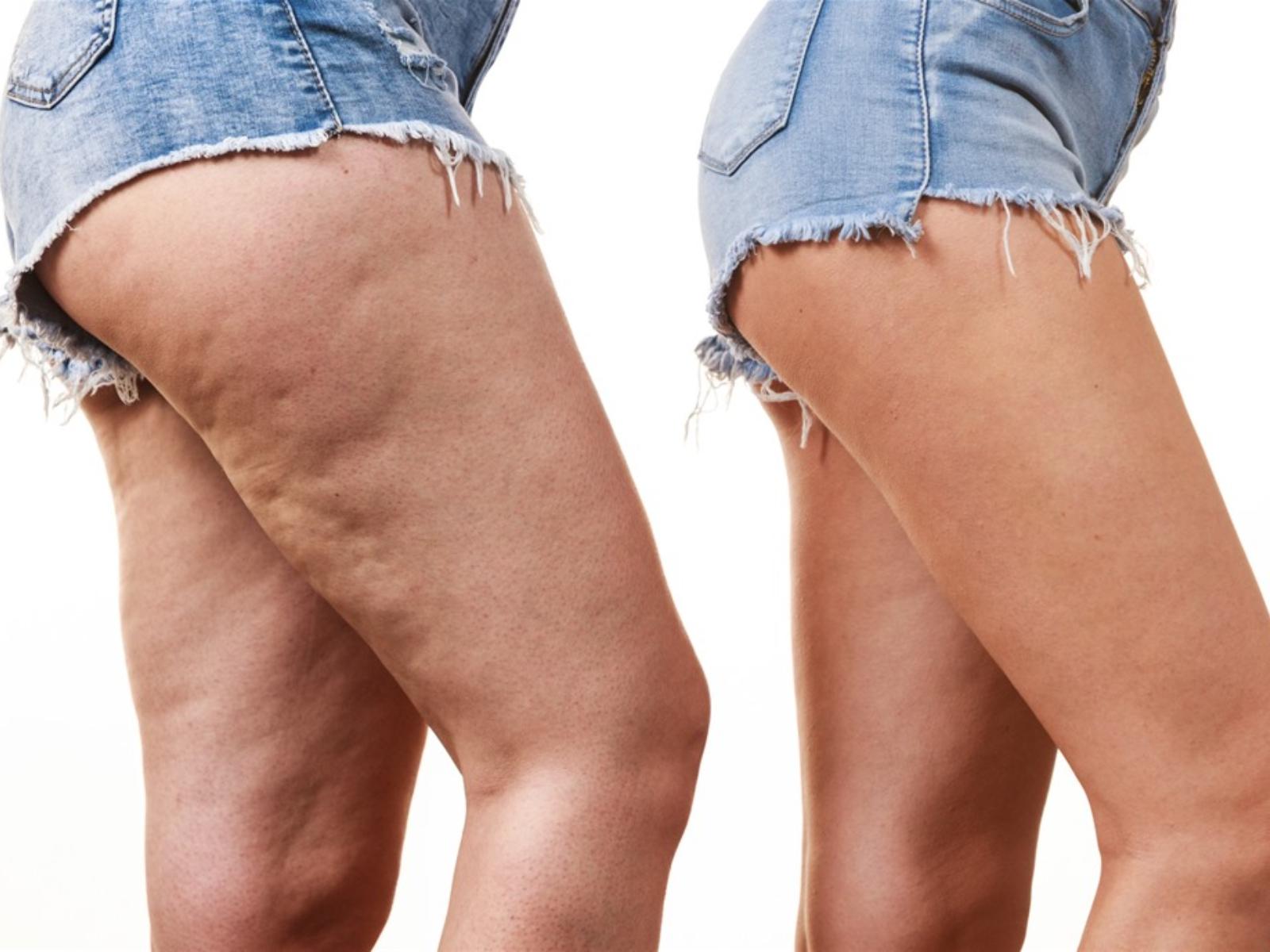 λαδάκι-για-την-κυτταρίτιδα-και-το-λίπος-