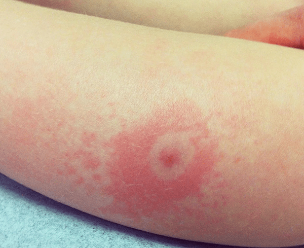 Μαύρη χήρα: Πόσο επικίνδυνο είναι το τσίμπημα για τα παιδιά – Τα ύποπτα συμπτώματα που μοιάζουν με αυτά της σκωληκοειδίτιδας