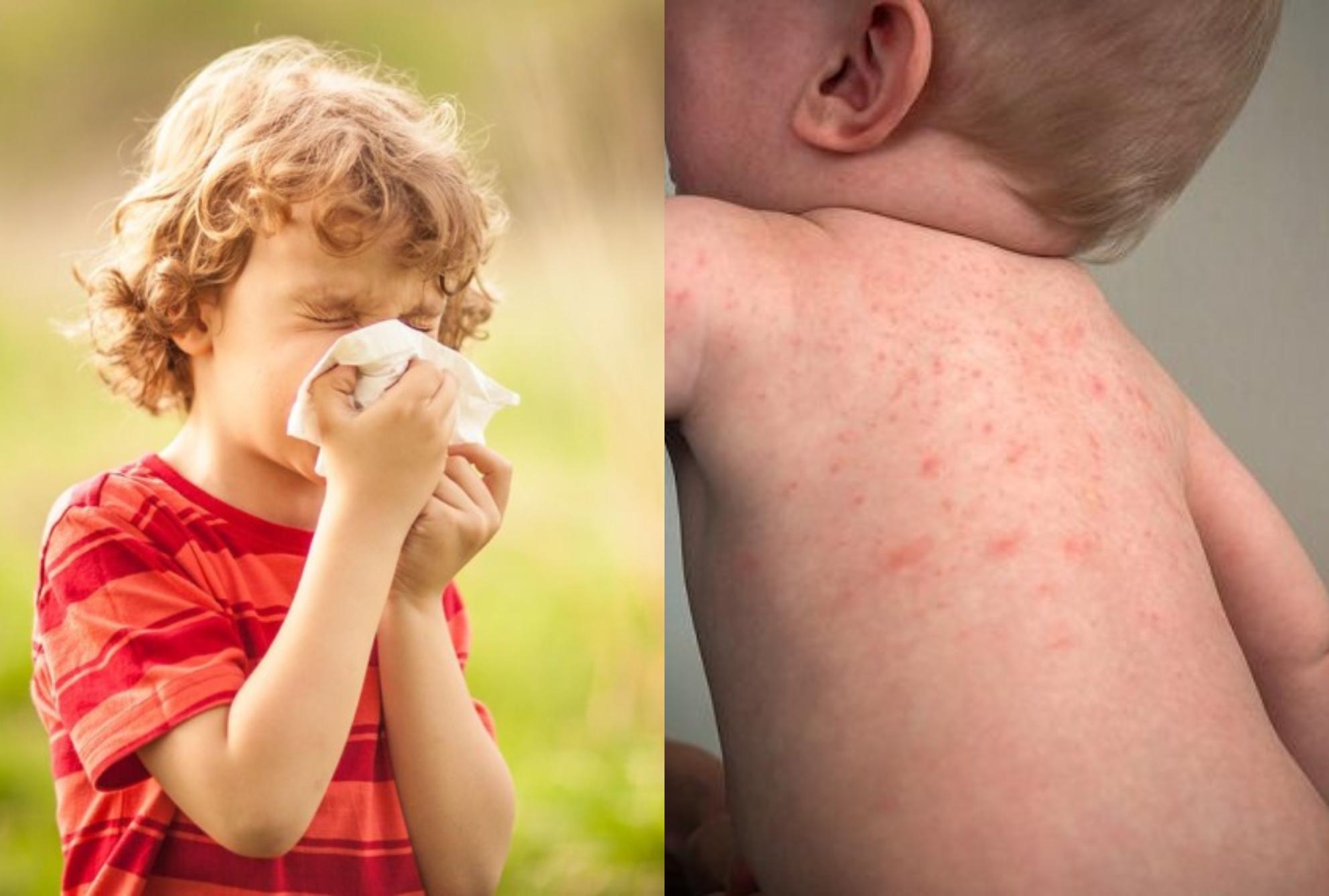 Παιδιά και αλλεργίες – Τα συμπτώματα και τι τις πυροδοτεί όλα όσα πρέπει να ξέρουν οι γονείς