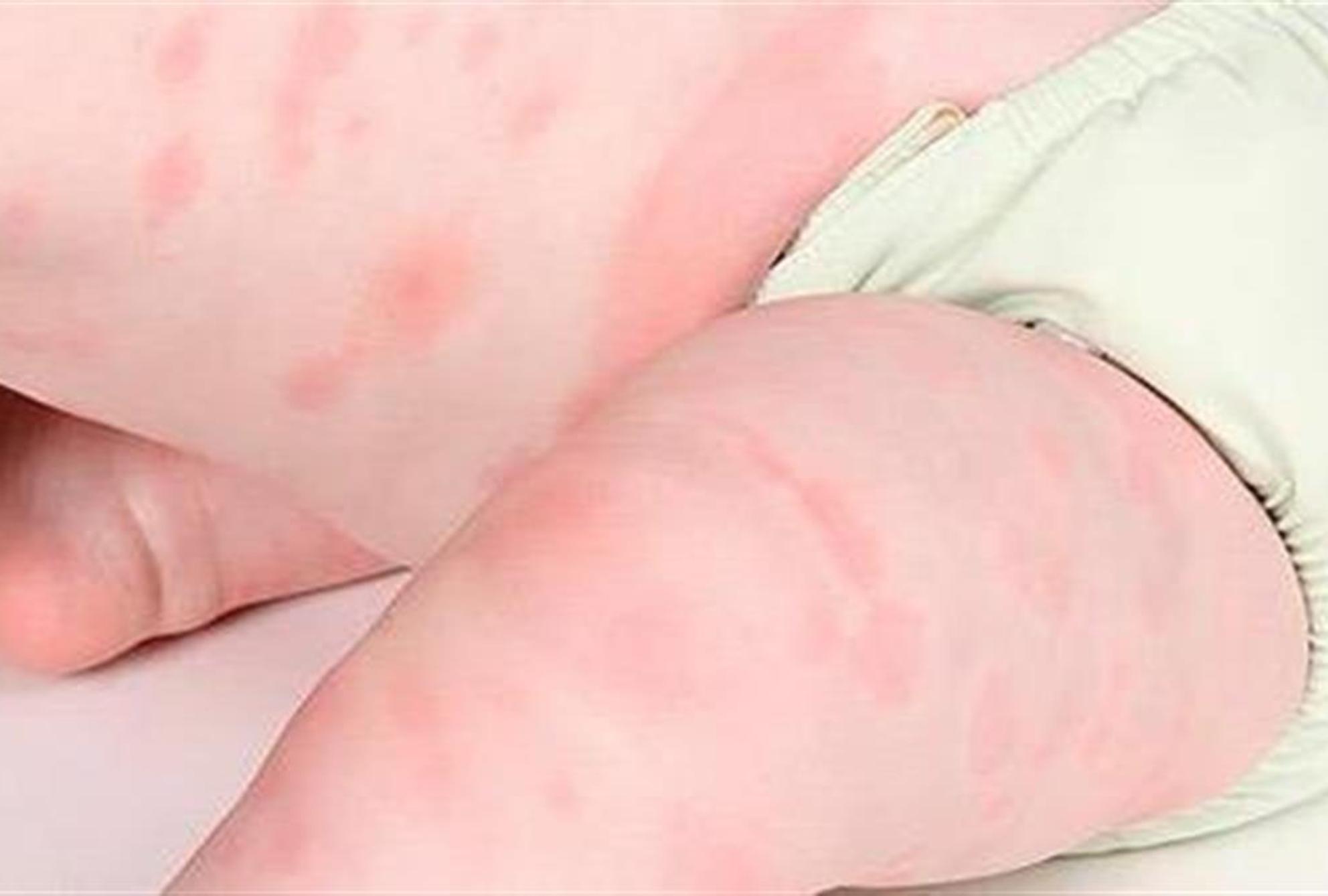 Παιδιά και αλλεργίες – Τα συμπτώματα και τι τις πυροδοτεί όλα όσα πρέπει να ξέρουν οι γονείς