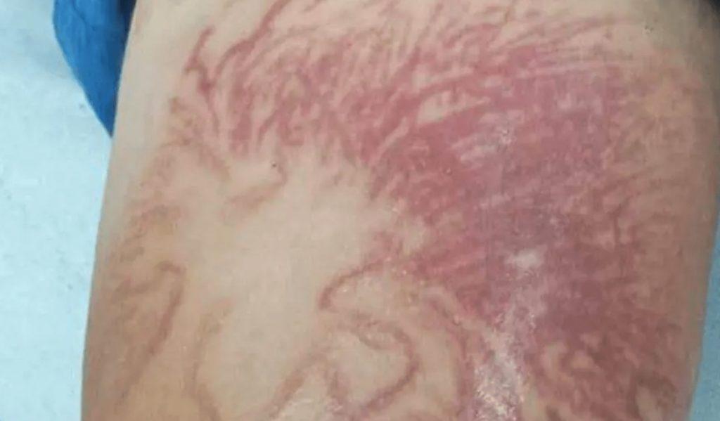 Κορίνθος: Στο νοσοκομείο  9χρονος – Τον τσίμπησε θαλάσσια ανεμώνη