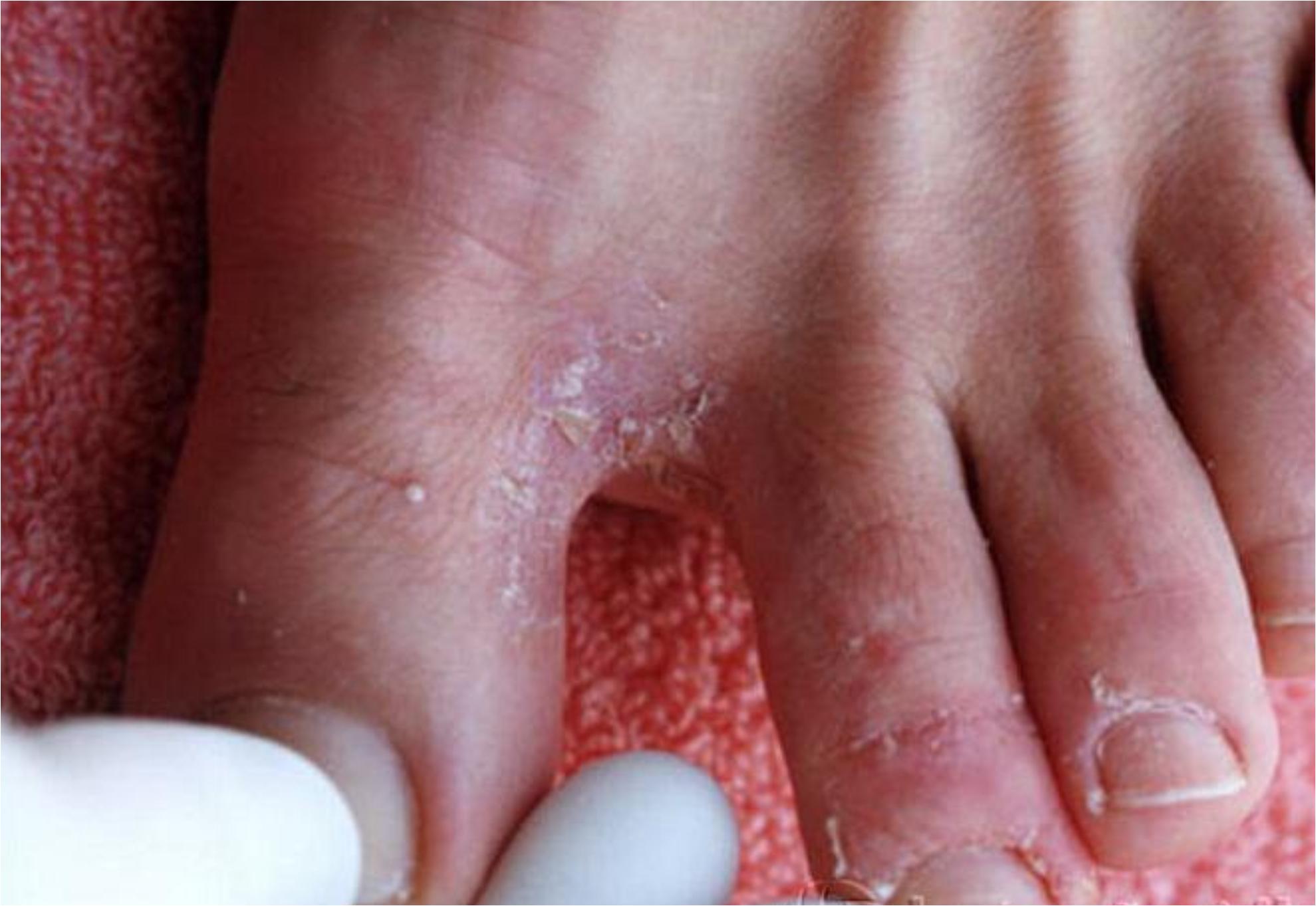 Μύκητες στα πόδια από την άμμο και τις σαγιονάρες το καλοκαίρι: Τα συμπτώματα και πως να τους αντιμετωπίσεις