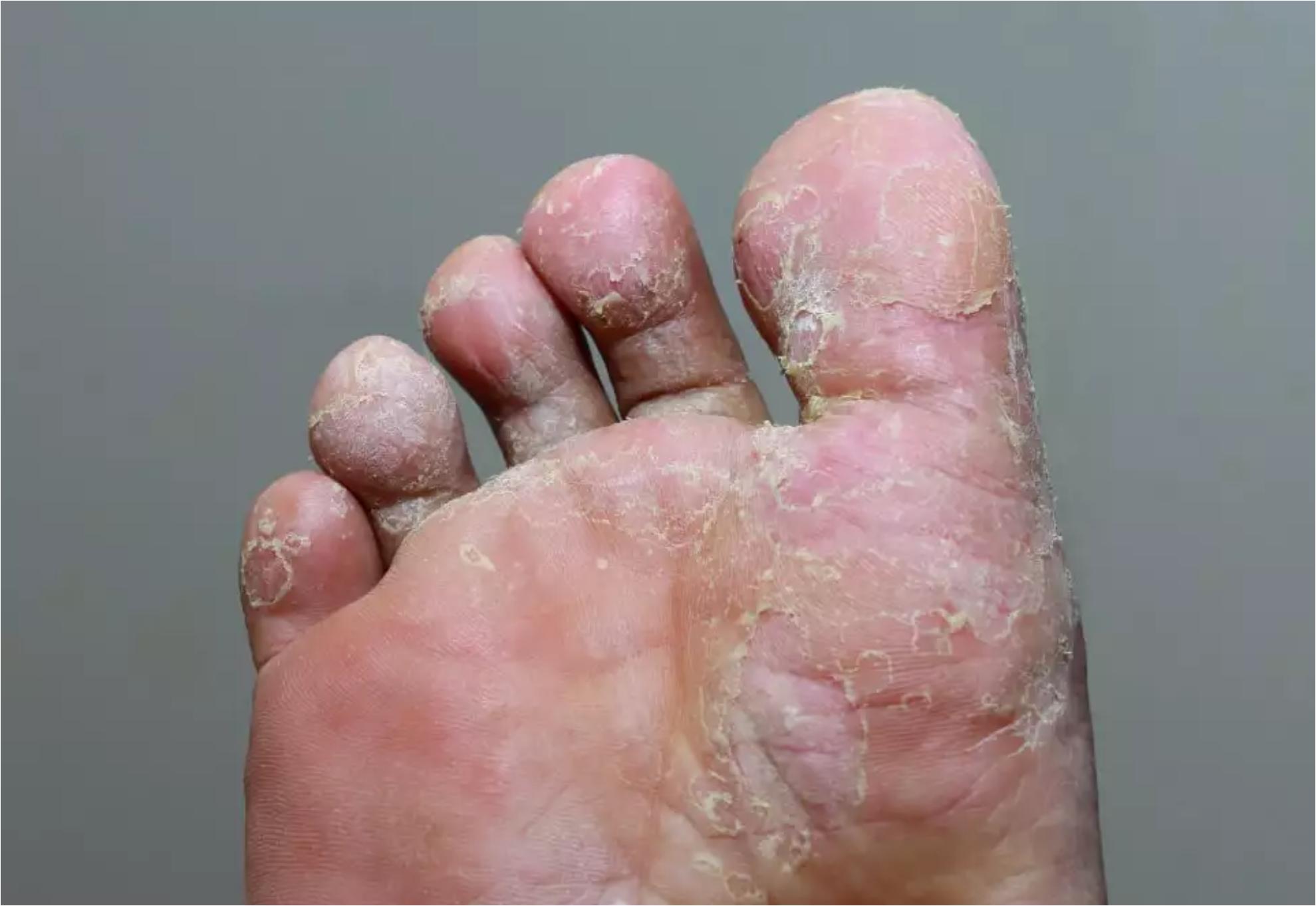 Μύκητες στα πόδια από την άμμο και τις σαγιονάρες το καλοκαίρι: Τα συμπτώματα και πως να τους αντιμετωπίσεις