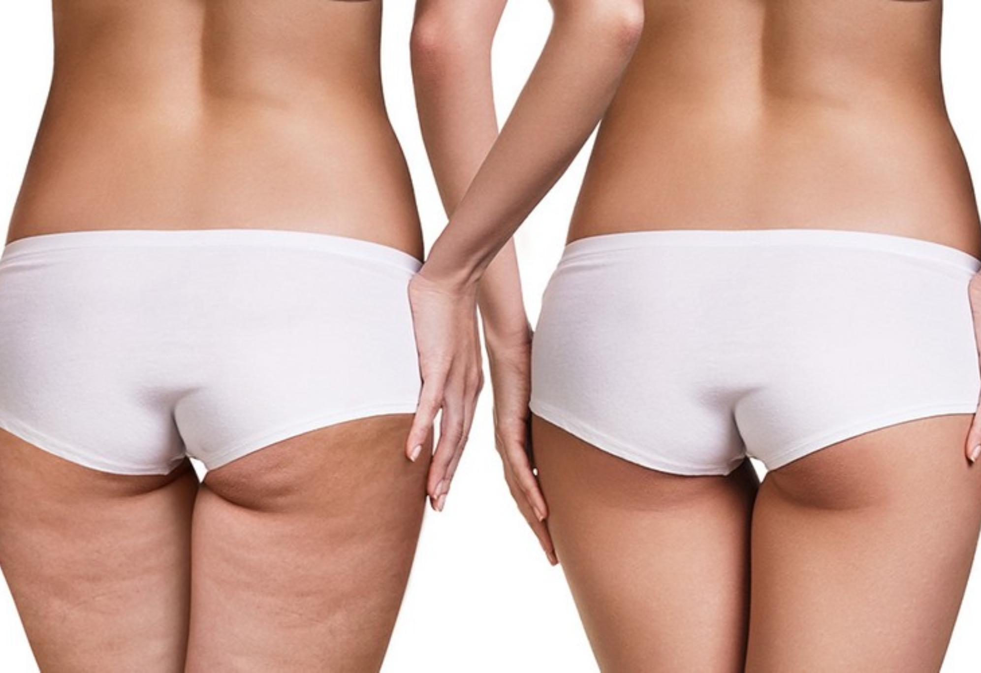 Κυτταρίτιδα στο πίσω μέρος των ποδιών απαλλάξου με απλό και φυσικό τρόπο