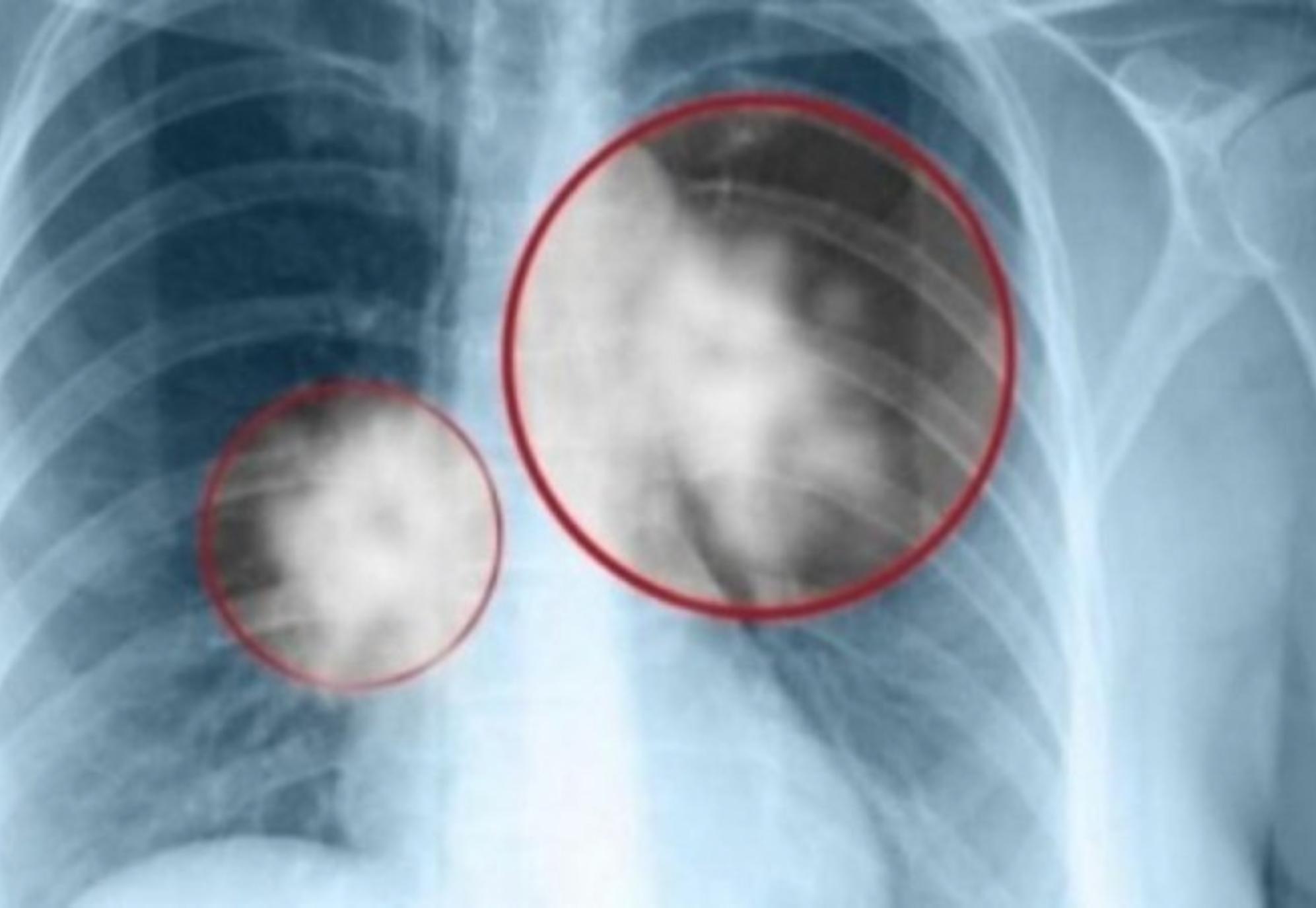 Τα πρώιμα σημάδια του καρκίνου που το 90% των ανθρώπων αγνοούν