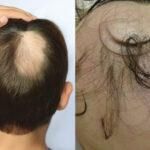 Τριχόπτωση στα παιδιά: Οι πιο συχνές αιτίες απώλειας των μαλλιών