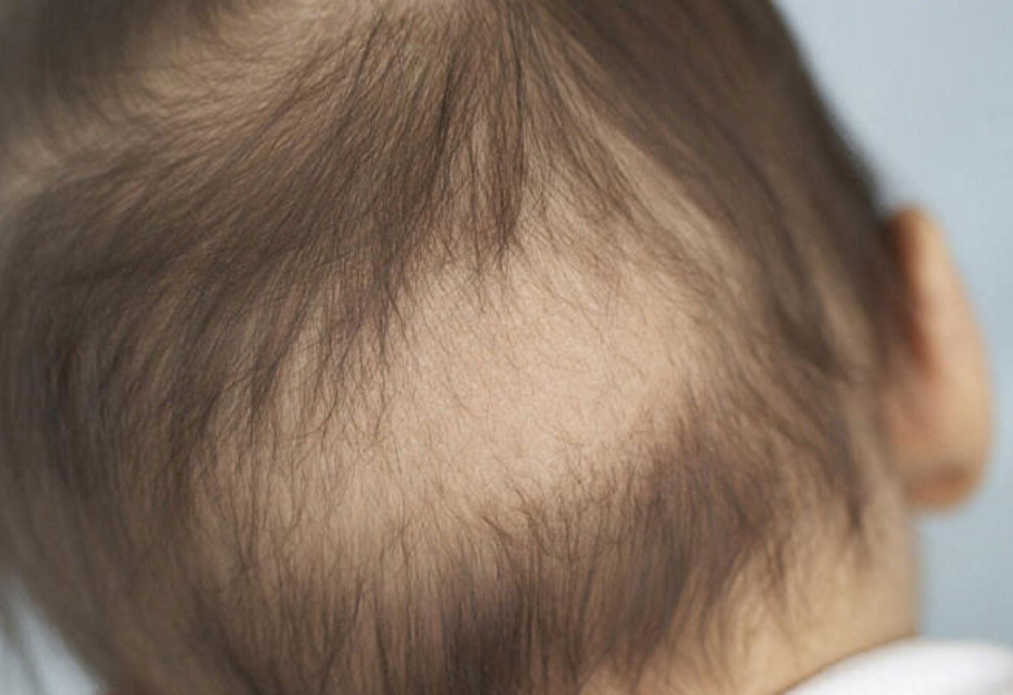 Τριχόπτωση στα παιδιά: Οι πιο συχνές αιτίες απώλειας των μαλλιών