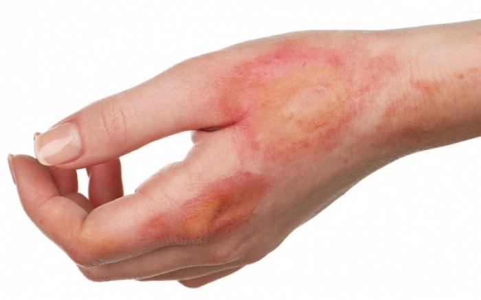 σοβαρή-μορφή-εγκαύματος-αντιμετώπιση- σοβαρή-μορφή-εγκαύματος-αντιμετώπιση-