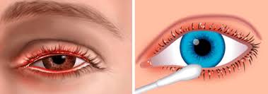 ασθένειες-στα-μάτια-από-τον-ήλιο-αντιμετώπιση-